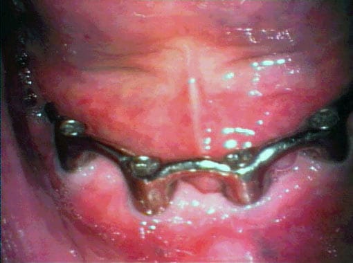 Det er normalt å ha etterkontroll av implantatene for å forsikre at det er friske forhold i munnen.