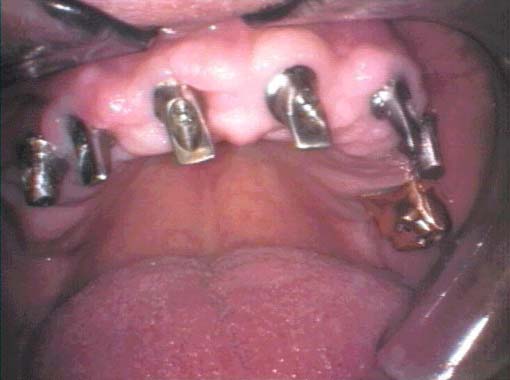Det monteres distanser i skruene for at implantatet skal sitte i riktig avstand til tannkjøttet.