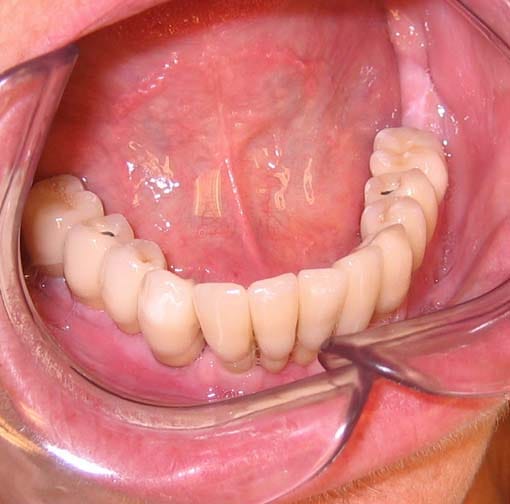 Tannbroen er skrudd fast i tannimplantatene, og sitter fast i kjeven.