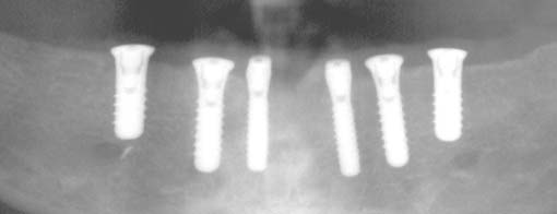 Røntgen av kjeven etter at tannimplantatskruer er festet for å gro fast.