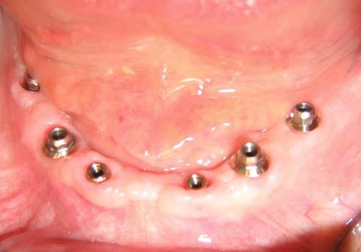 Tannlegen installerer forlengelser av skruefestene slik at protesen får en god posisjon i munnhulen.
