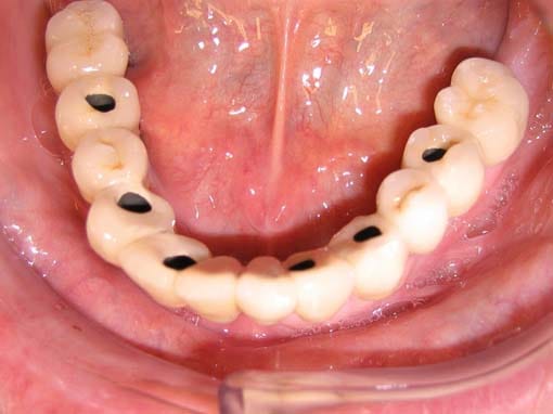 Protesen som også kalles en bro, skrus fast i implantatene gjennom de kunstige tennenes overflate.