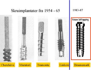 Skruimplantater har sett mange former og fasonger opp gjennom årene, og minner i stor grad om det ypperlige produktet vi bruker den dag i dag.